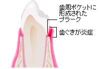 歯周ポケットに形成されたプラーク 歯ぐきが炎症